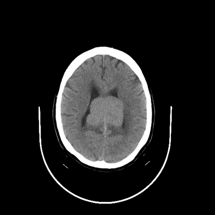 Primary CNS Lymphoma | Radiology Case | Radiopaedia.org