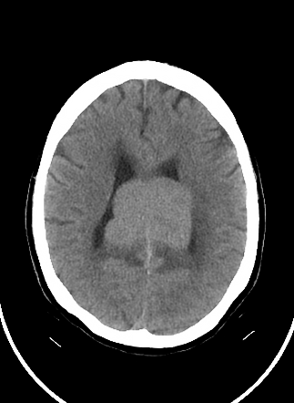 Primary CNS lymphoma | Radiology Case | Radiopaedia.org