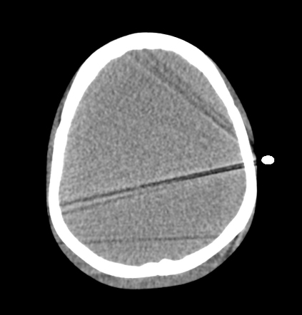 Streak artifact due to leads - anthropomorphic phantom (CT head ...