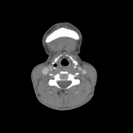 Relapsing polychondritis | Radiology Case | Radiopaedia.org