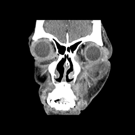 Odontogenic Orbital Cellulitis 