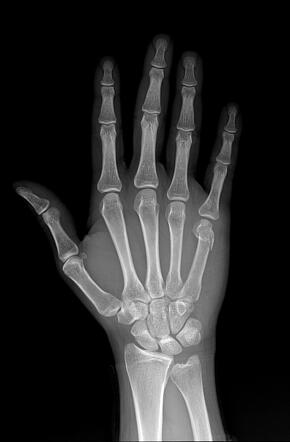 Boxer fracture | Radiology Case | Radiopaedia.org