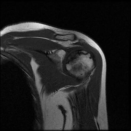 Osteonecrosis of the humeral head | Radiology Case | Radiopaedia.org