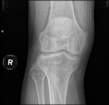 Pellegrini-Stieda lesion | Radiology Case | Radiopaedia.org