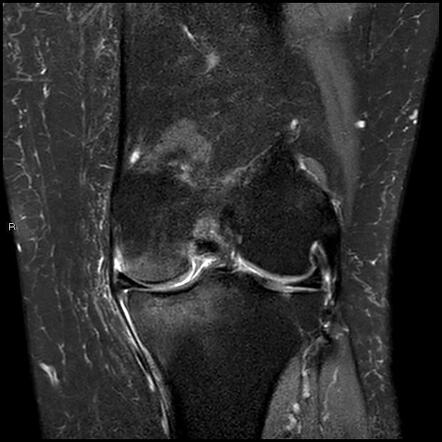 Subchondral Insufficiency Fracture Of The Knee And Complex Meniscal ...