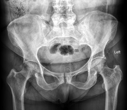 Iliolumbar ligament ossification | Radiology Case | Radiopaedia.org