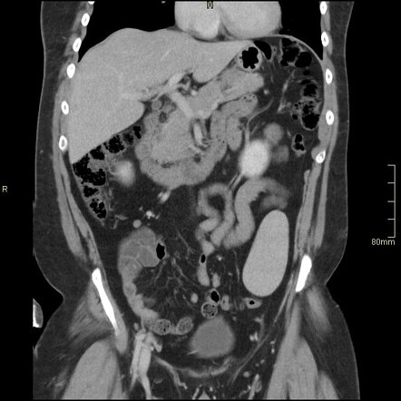 Wandering spleen | Radiology Case | Radiopaedia.org