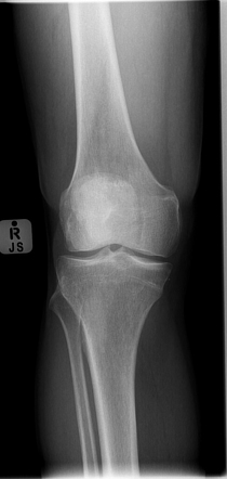 Epiphyseal scar (tibia) | Radiology Case | Radiopaedia.org