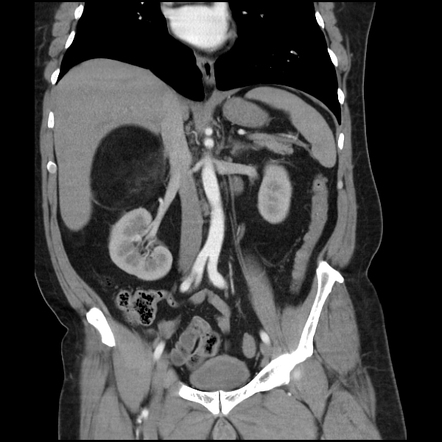 Giant adrenal myelolipoma | Radiology Case | Radiopaedia.org