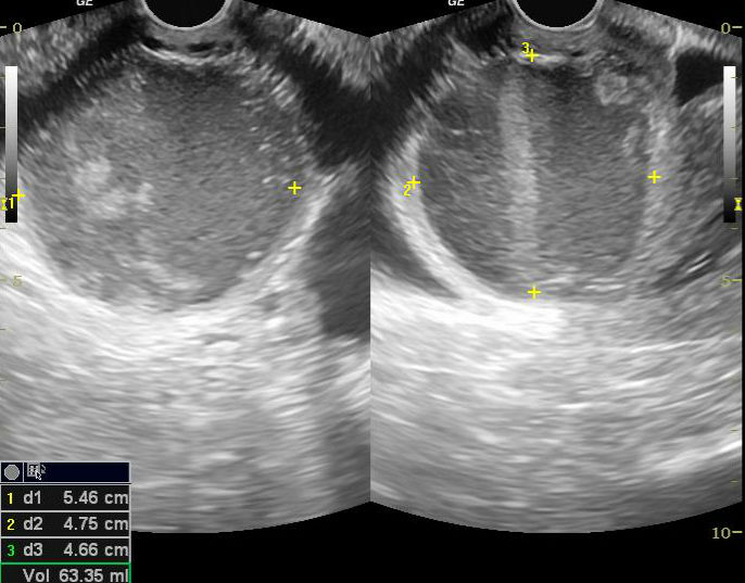 Haematometrium | Image | Radiopaedia.org