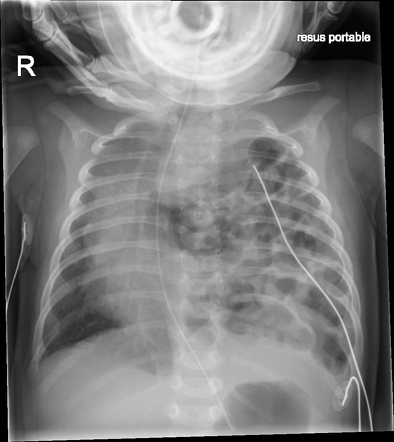 Postnatal diagnosis of congenital diaphragmatic hernia | Radiology Case ...