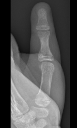 Salter-Harris type II fracture | Radiology Case | Radiopaedia.org