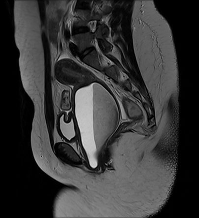 Imperforate hymen | Radiology Case | Radiopaedia.org