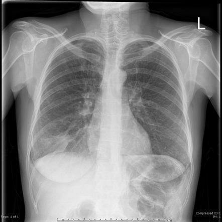 Pneumatosis coli | Radiology Case | Radiopaedia.org