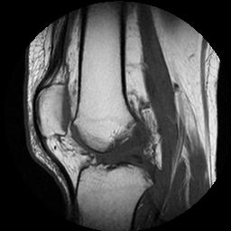 Displaced flap tear of medial meniscus | Image | Radiopaedia.org