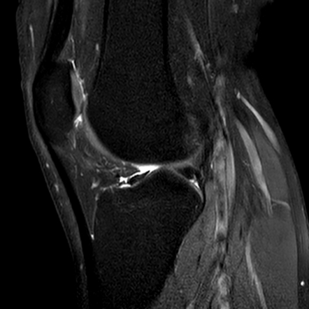 Absent Anterior Cruciate Ligament 