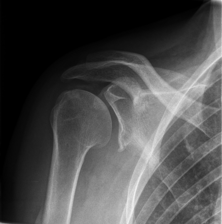 Glenoid dysplasia | Radiology Case | Radiopaedia.org