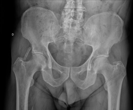 Rectus femoris heterotopic ossification | Radiology Case | Radiopaedia.org