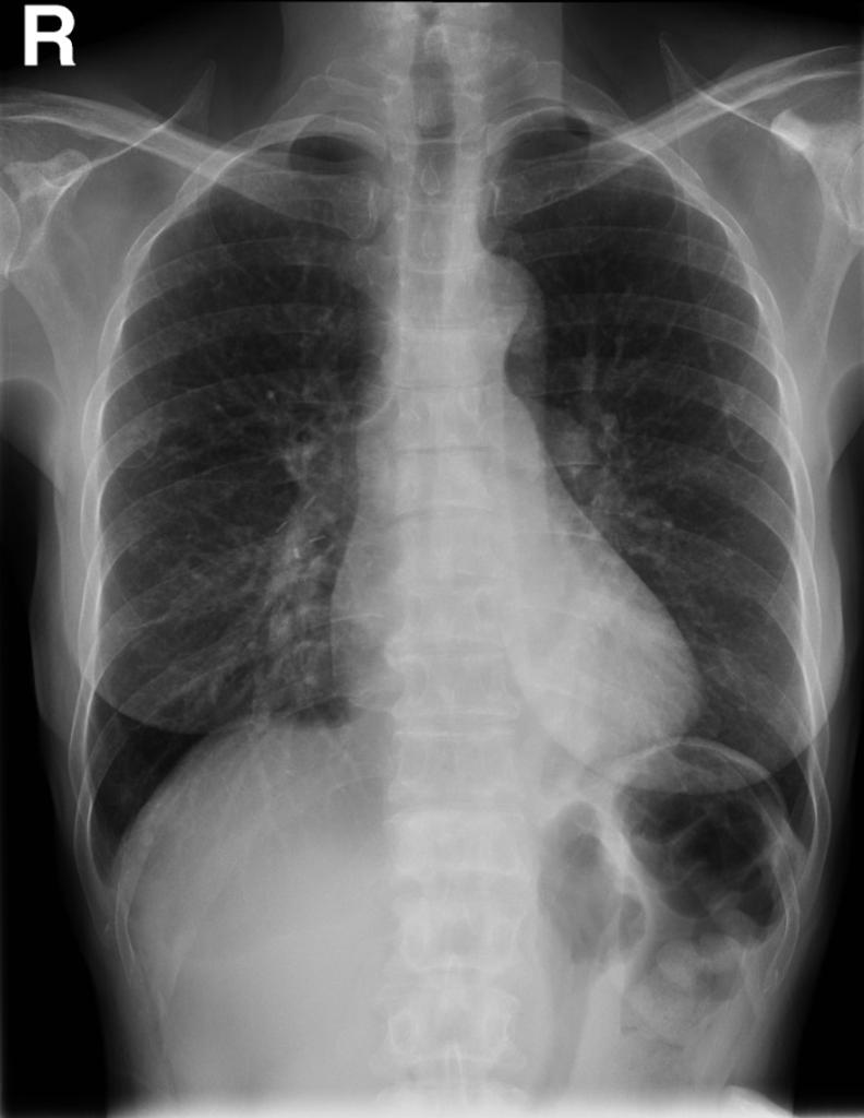 Lung Metastases From Breast Cancer Radiology Case Radiopaedia Org