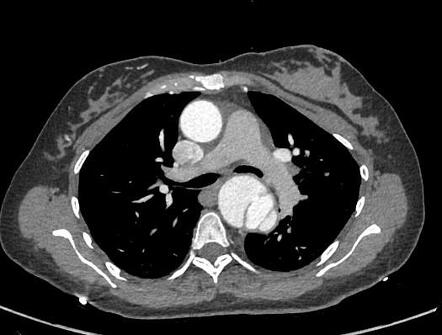 Postpartum aortic dissection | Radiology Case | Radiopaedia.org