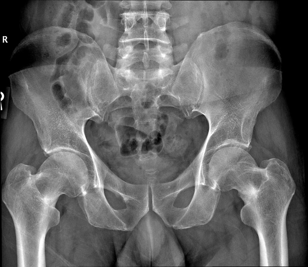 Bilateral femoral neck stress fractures | Radiology Case 