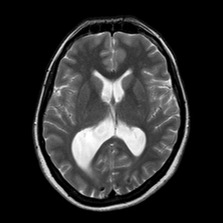 Congenital cerebral toxoplasmosis | Radiology Case | Radiopaedia.org