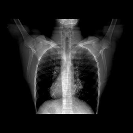 Kartagener syndrome | Radiology Case | Radiopaedia.org