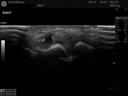 Acromioclavicular ligament rupture | Radiology Case | Radiopaedia.org