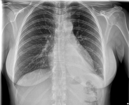 Bronchial carcinoid | Radiology Case | Radiopaedia.org