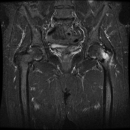 Bilateral femoral neck stress fractures | Image | Radiopaedia.org