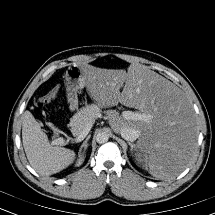 Situs inversus totalis with left-sided acute appendicitis | Radiology ...