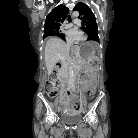 Transcoelomic spread of breast cancer | Radiology Case | Radiopaedia.org