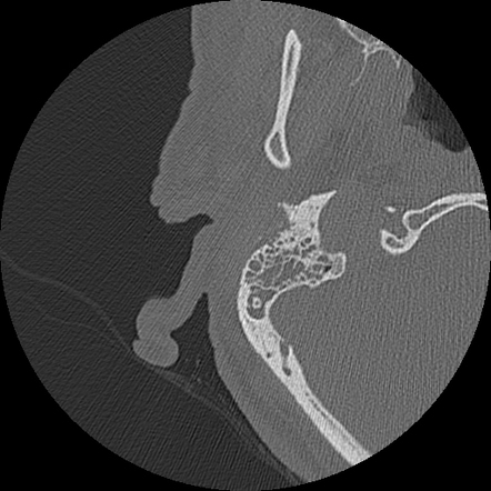 otitis externa case study