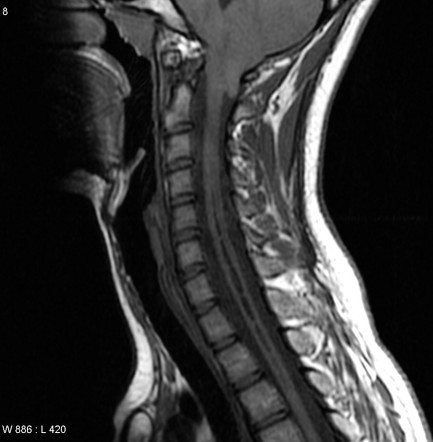 Neurosarcoidosis and Chiari I malformation | Image | Radiopaedia.org