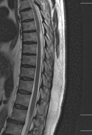 Dorsal thoracic arachnoid web | Radiology Case | Radiopaedia.org