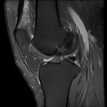 Anterior suprapatellar fat pad impingement | Radiology Case ...