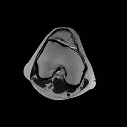 Trochlear dysplasia Type C sec. Dejour | Radiology Case | Radiopaedia.org