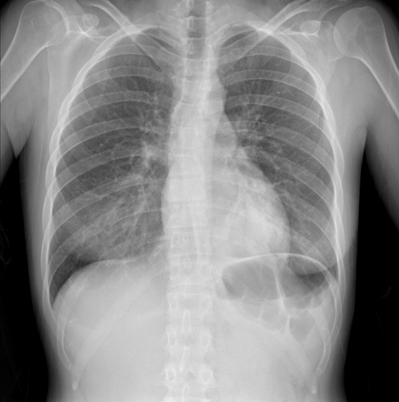 Left lower lobe consolidation | Radiology Case | Radiopaedia.org