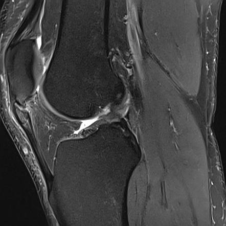 Jumper's knee | Radiology Case | Radiopaedia.org