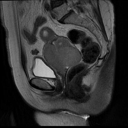 Cervical carcinoma | Radiology Case | Radiopaedia.org