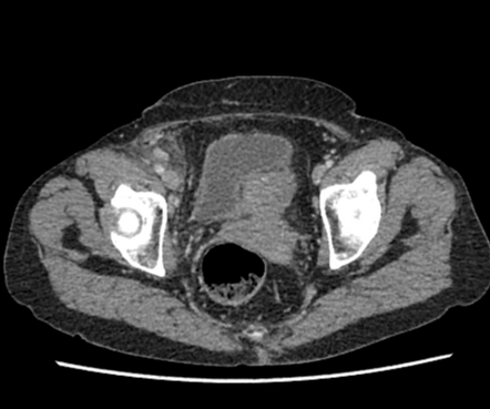 Appendiceal adenocarcinoma | Radiology Case | Radiopaedia.org