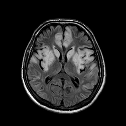 Acute hyperammonaemic encephalopathy | Radiology Case | Radiopaedia.org