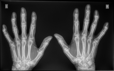 Erosive osteoarthritis | Radiology Case | Radiopaedia.org