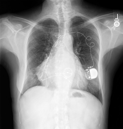 Pacemaker lead fracture | Radiology Case | Radiopaedia.org