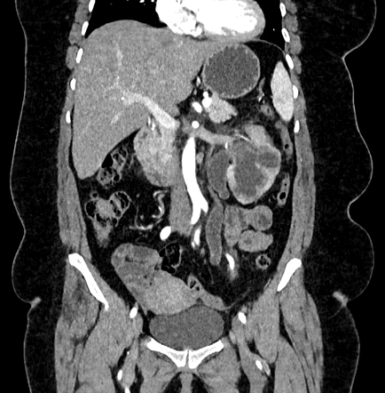 Obstructed Primary Megaureter Radiology Case Radiopaedia Org