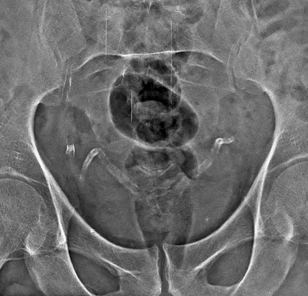 Calcified seminal vesicles and vas deferens | Radiology Case ...