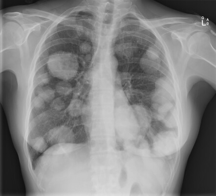 Cannonball metastases | Radiology Case | Radiopaedia.org