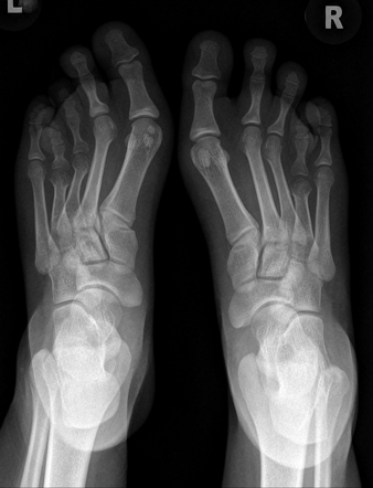 Brachymetatarsia | Radiology Case | Radiopaedia.org