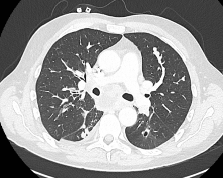 Pulmonary tumour embolism | Radiology Case | Radiopaedia.org