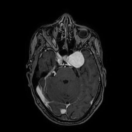 ICA aneurysm | Radiology Case | Radiopaedia.org